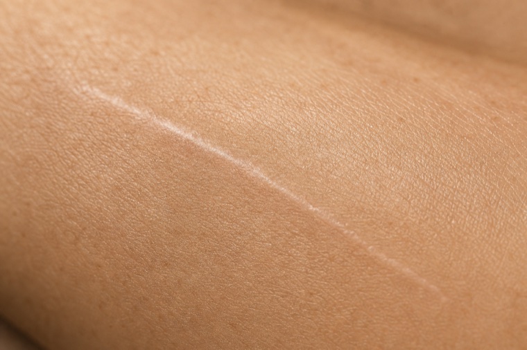 Skin texture showing a healed scar