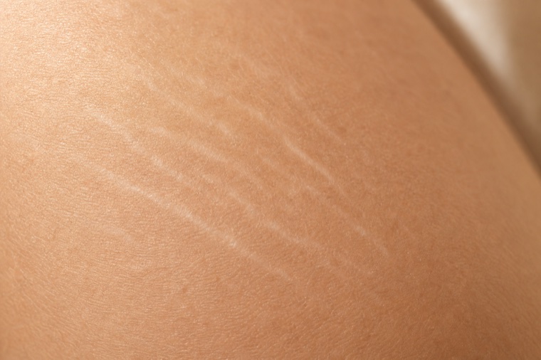 Skin texture showing stretch marks